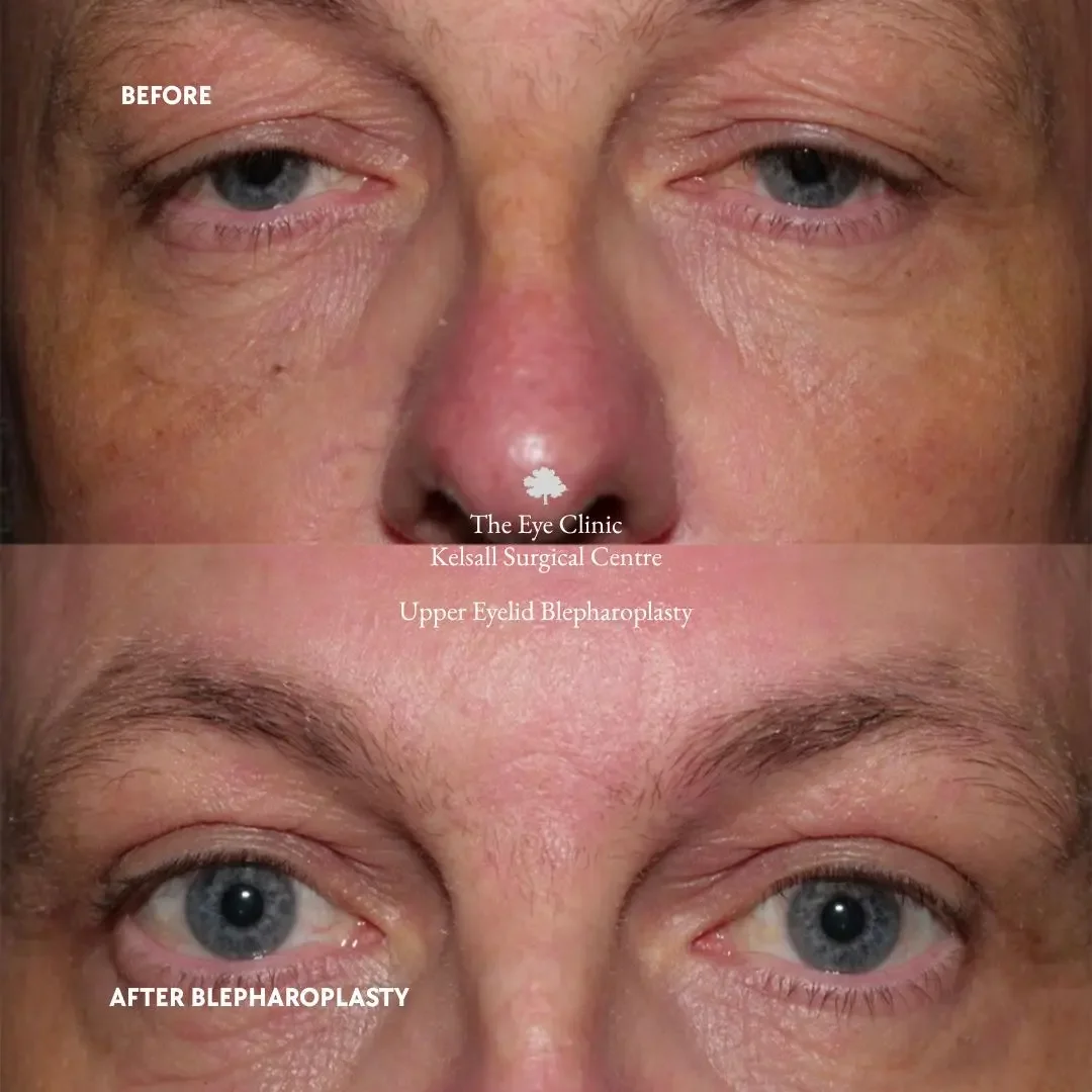 Before and after photos of a person who underwent upper eyelid blepharoplasty. The top image shows sagging eyelids, and the bottom image shows the improved eyelid appearance after surgery.
