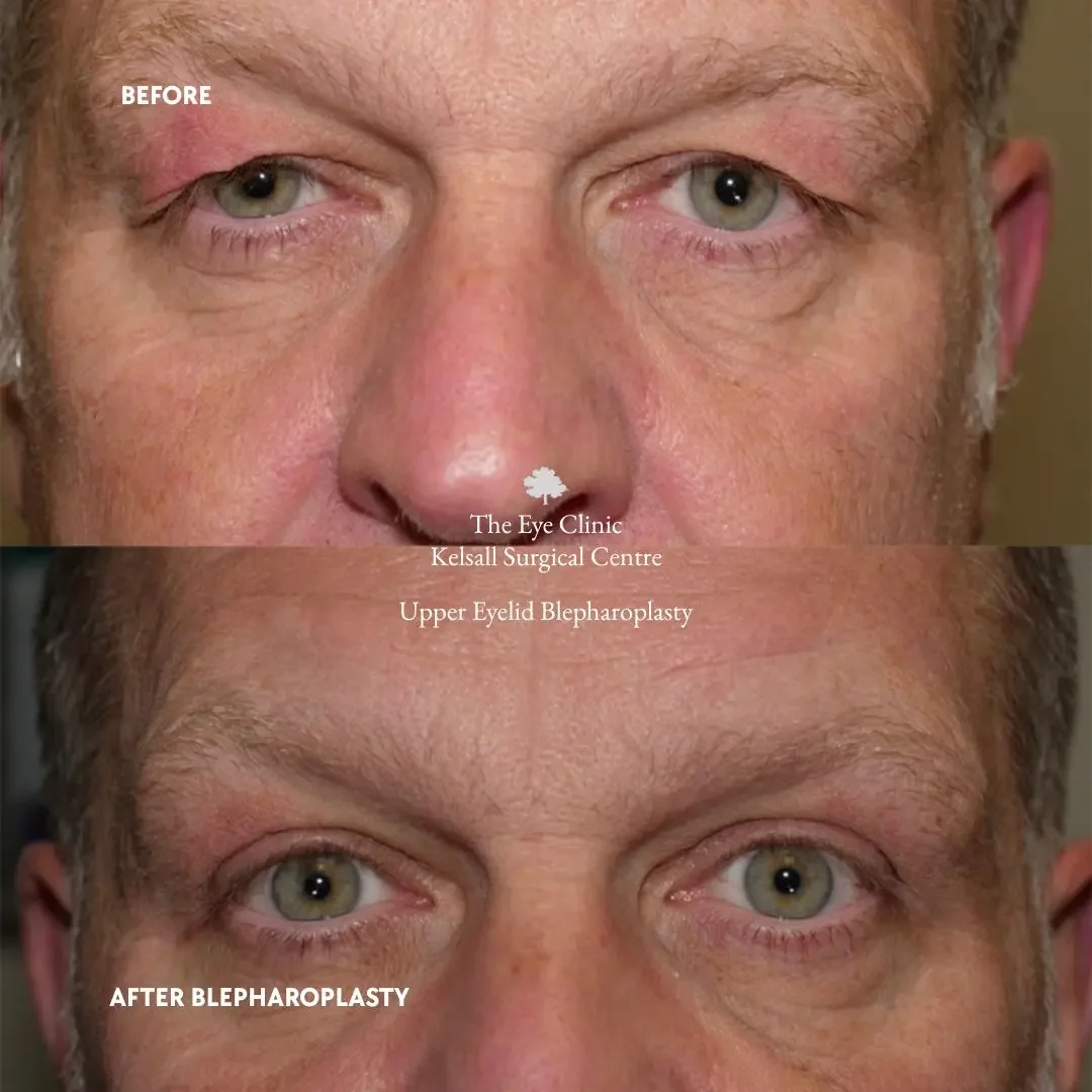 Close-up of a man's face before and after upper eyelid blepharoplasty, showing reduced eyelid sagging and wrinkles.