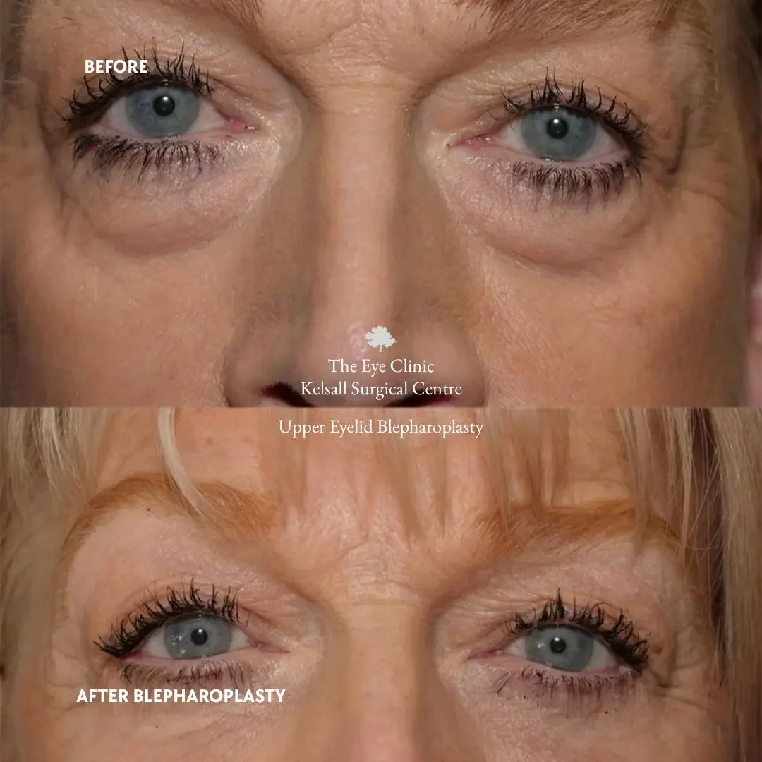 Close-up of a woman's eyes and upper face showing before and after upper eyelid blepharoplasty treatment, with text indicating the procedure was performed at The Eye Clinic Kelsall Surgical Centre.