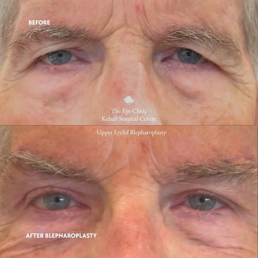 Before and after images of a man after eyelid surgery