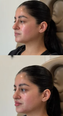Side profile of a woman with dark hair slicked back, showing before and after images of her face.