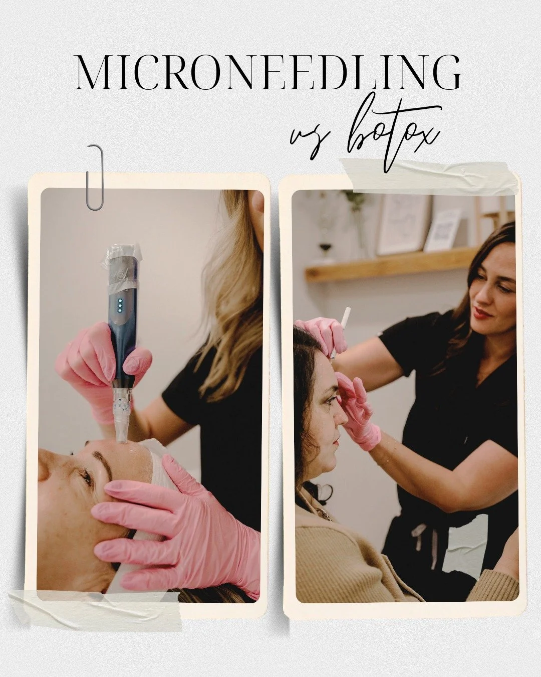 Microneedling vs. Botox &mdash; what&rsquo;s the difference?
Both are amazing&hellip; they just work differently 🤍
💉 Botox
&bull; Smooths wrinkles almost instantly
&bull; Typically booked every 3 months
&bull; Perfect for dynamic lines + fast resul