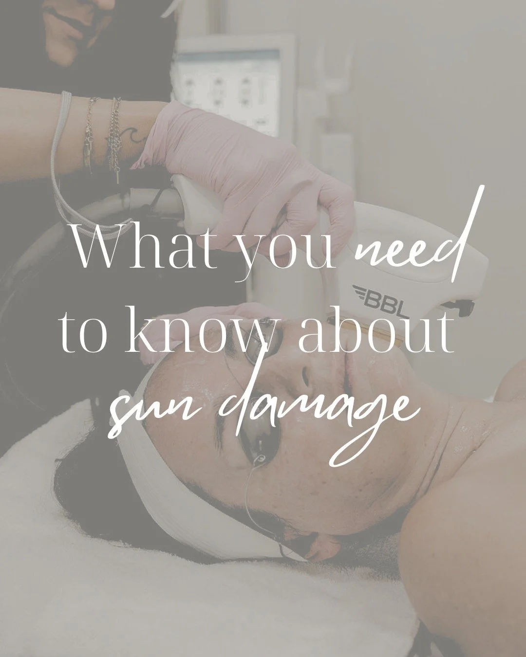 A lot of what we blame on &ldquo;aging&rdquo; is actually sun exposure over time.
UV damage shows up as pigment, redness, and texture changes long before we realize it.

This is why we love BBL + MOXI laser 
BBL targets visible sun damage like pigmen