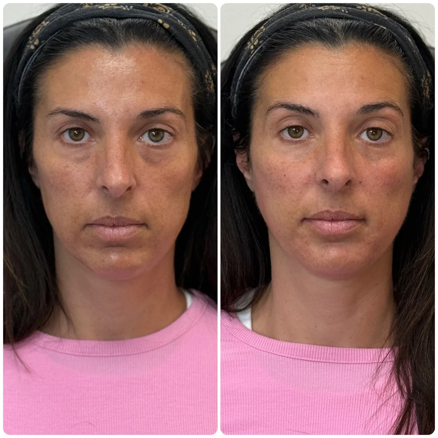 The results of our training with the very talented and beautiful @daniella.cnp !! 💉🫶🏻

Areas we injected and with what product: 
- 1 vial of sculptra to periform fossa and prearicular
- 1 syringe of contour for c curve support 
- 1 syringe of defy