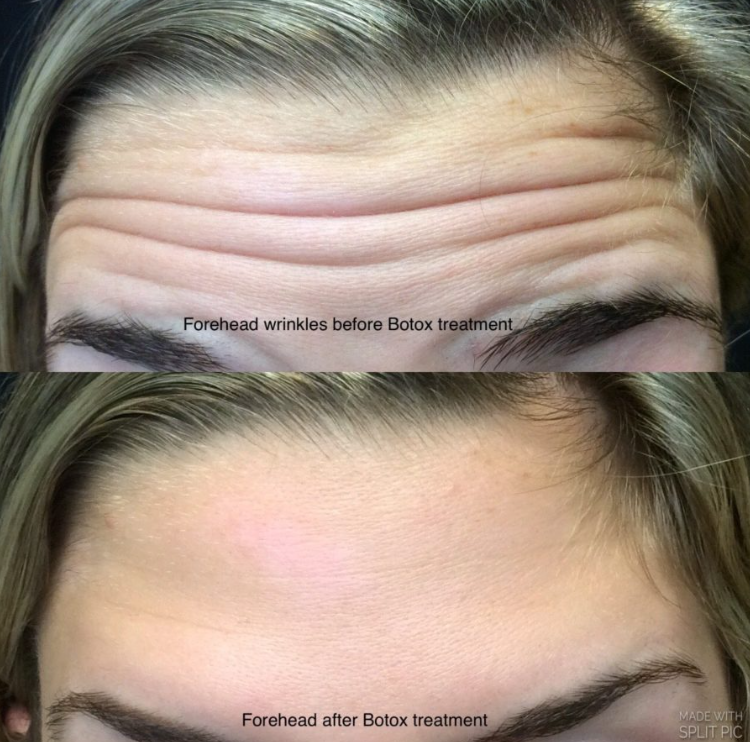 Side-by-side comparison of a person's forehead showing wrinkles before and after Botox treatment. The top image shows deep forehead wrinkles, while the bottom image shows a smooth forehead with no wrinkles.
