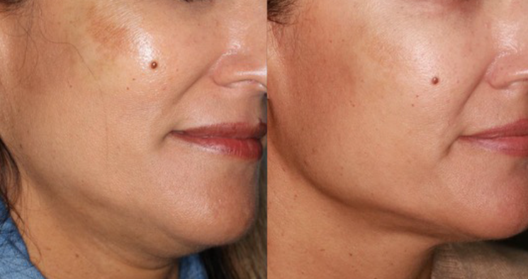 Close-up side-by-side comparison of a woman's cheek showing skin improvement, with a small mole near her nose.
