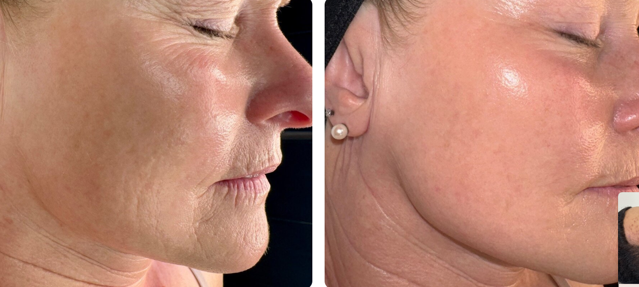 Close-up view of a woman's face showing before and after skin treatment results, focused on cheek and jawline area.