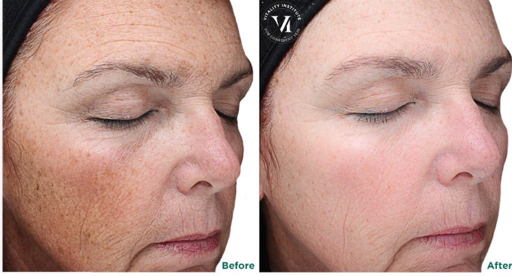 Close-up of a woman's face showing a before-and-after comparison. The left side shows her skin with age spots and uneven texture; the right side shows clearer, smoother skin after treatment.