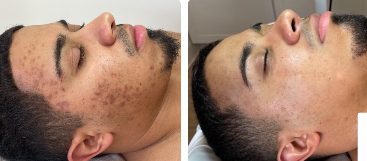 Side-by-side comparison of a man's face before and after acne treatment, showing clear improvement.