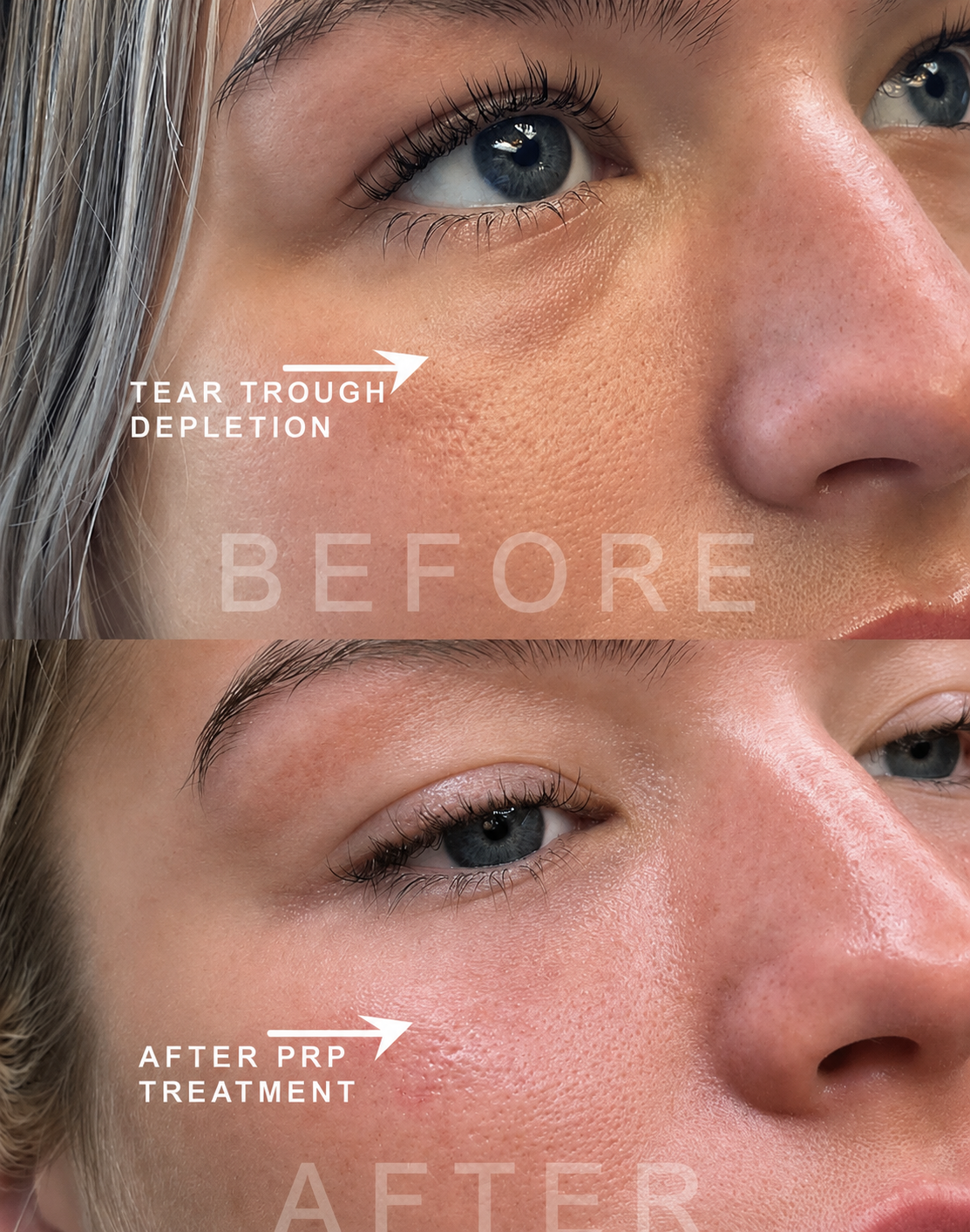 Close-up comparison of a woman's cheek before and after PRP treatment, showing improvements in tear trough depletion and skin texture.