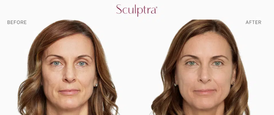 Side-by-side comparison of a woman's face before and after Sculptra treatment, showing smoother skin and reduced wrinkles on the right