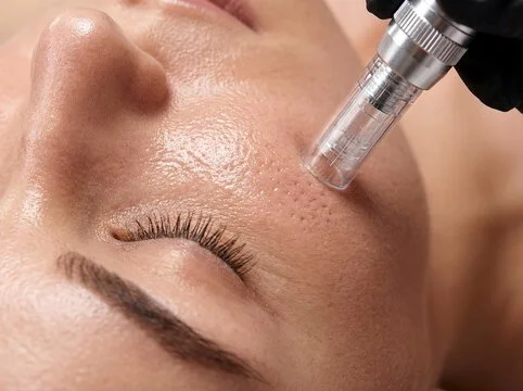 microneedling.jpg