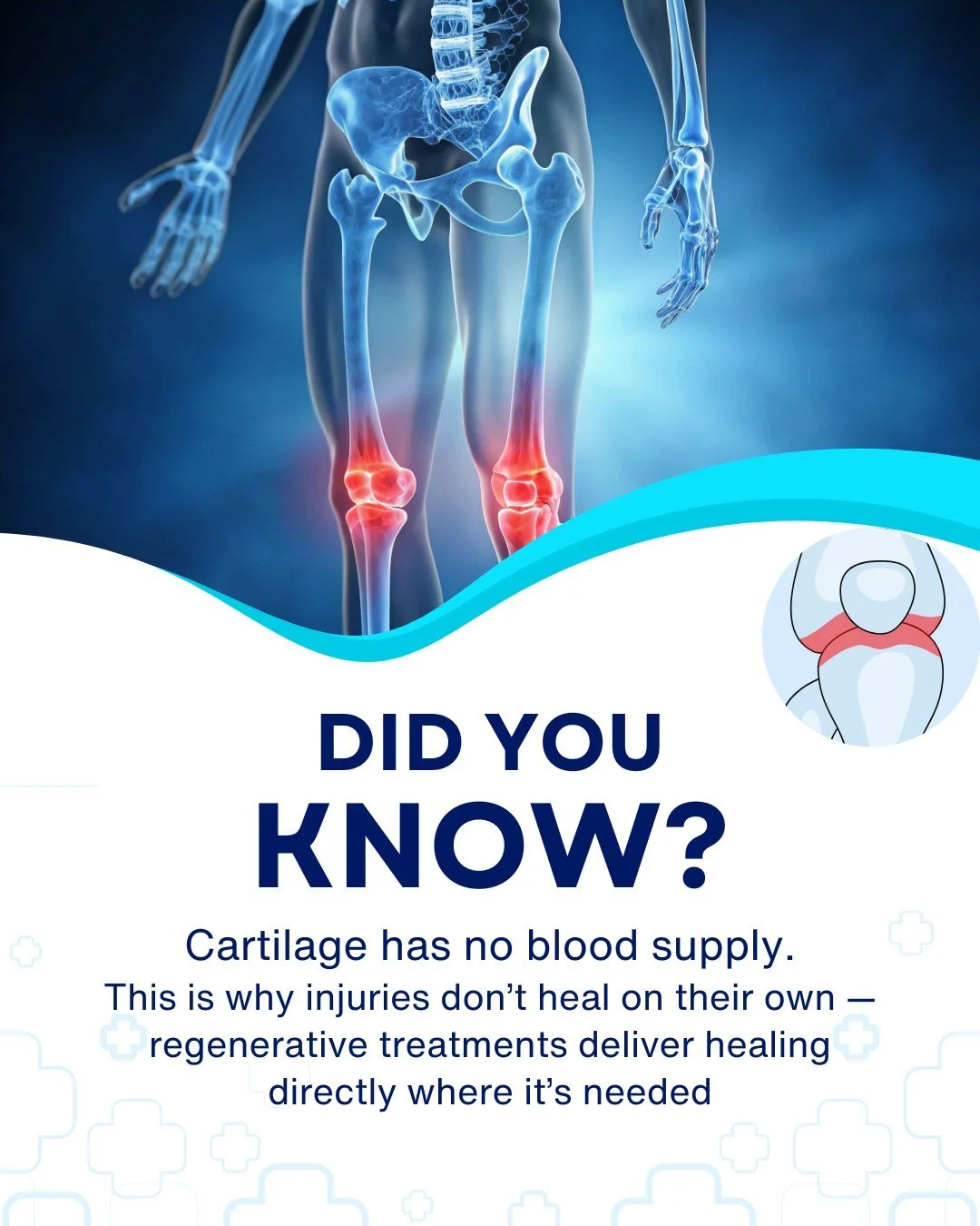 Did you know your cartilage has no direct blood supply?
That&rsquo;s why once it&rsquo;s damaged, it struggles to heal on its own.

✨ With regenerative medicine, we&rsquo;re able to deliver concentrated healing cells + growth factors directly to the 