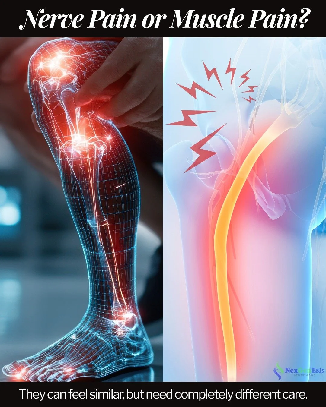 Nerve pain and muscle pain can feel similar &mdash; but the source (and treatment) are very different. 

If your pain feels sharp, burning, or radiates down your leg or arm&hellip; it may be nerve-related.

At NexGenEsis, our regenerative treatments 