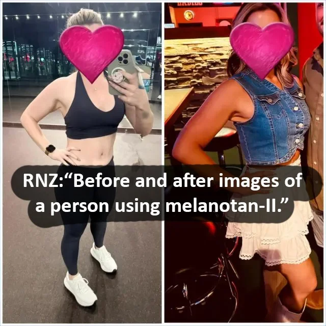 Before and after images of a person using melanotan-II