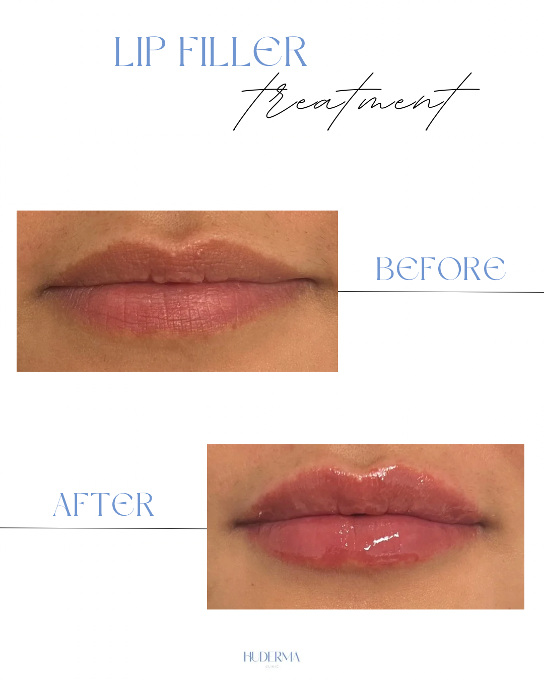 Before and after lip filler treatment at HuDerma Clinic Harley Street London showing natural volume enhancement