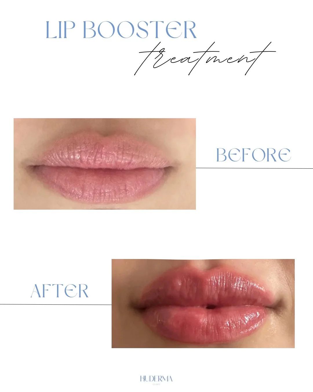 Before and after skin booster treatment at HuDerma Clinic Harley Street London showing improved skin texture and hydration