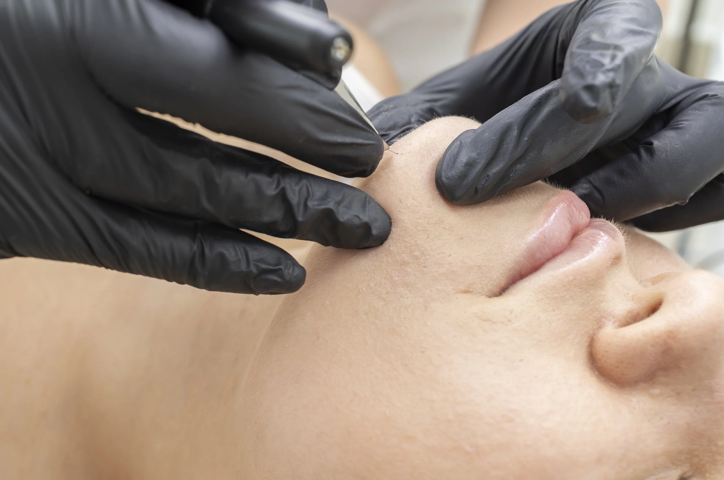 Electrolysis hair removal treatment being performed on facial hair at HuDerma Clinic