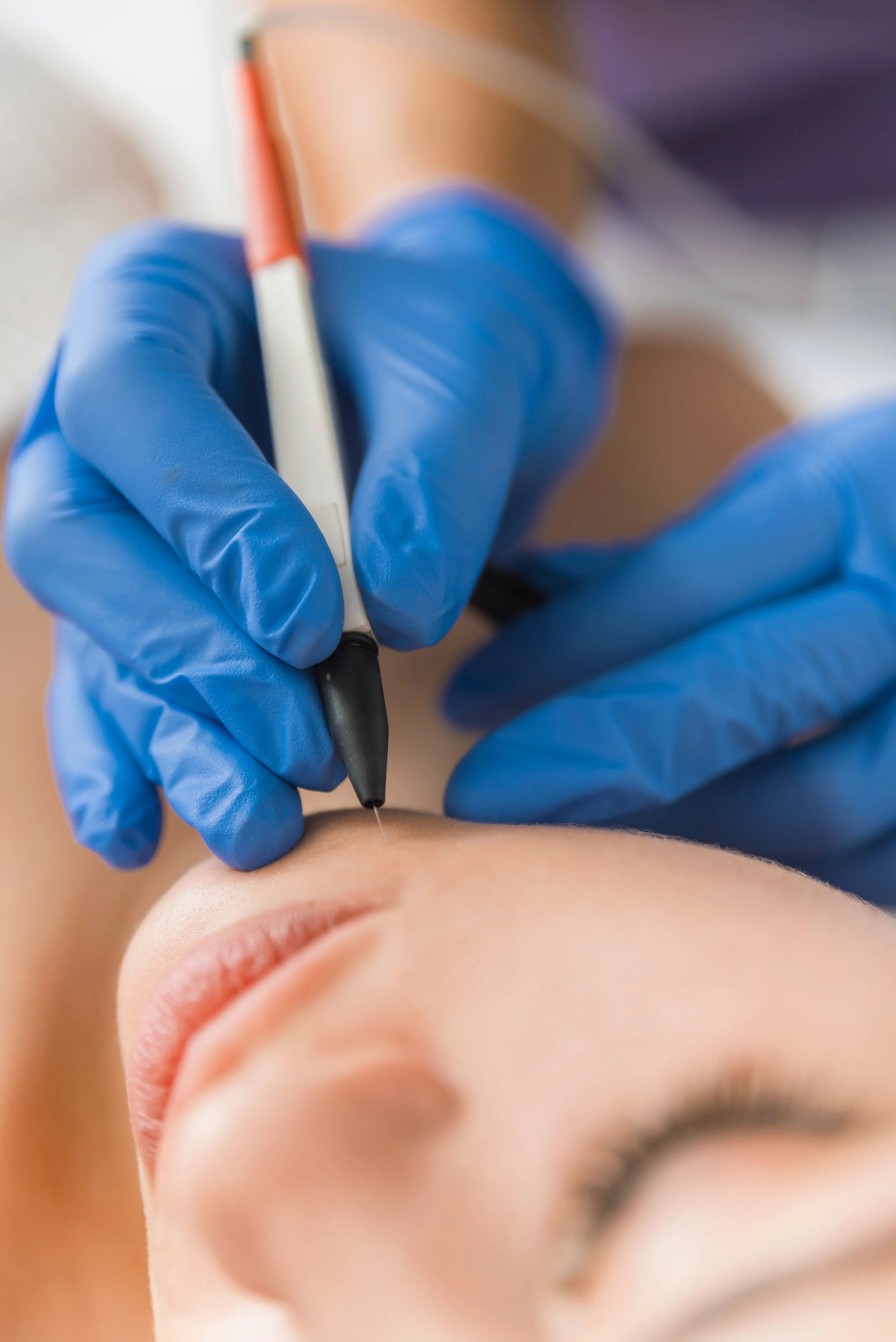 Close-up of electrolysis hair removal treatment for permanent facial hair reduction