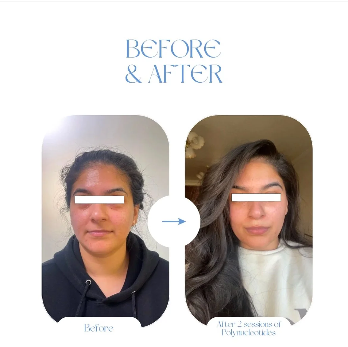 Before and after polynucleotides treatment at HuDerma Clinic Harley Street London showing improved skin texture and radiance