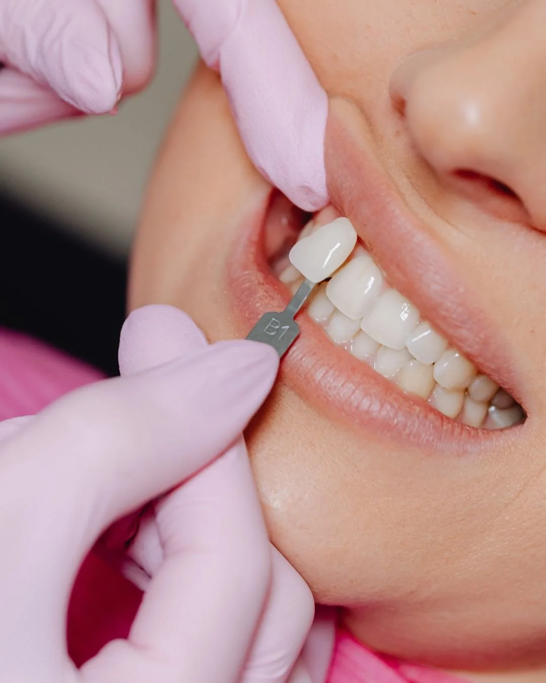 Thinking about veneers?

At Smile Haus, veneer consultations are tailored to you. We consider your aesthetic goals, facial features, bite, and overall dental health to determine whether veneers are appropriate and what approach will deliver the most 