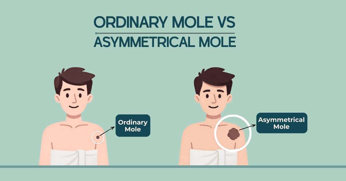 Asymmetry in Moles: Key Skin Cancer Warning