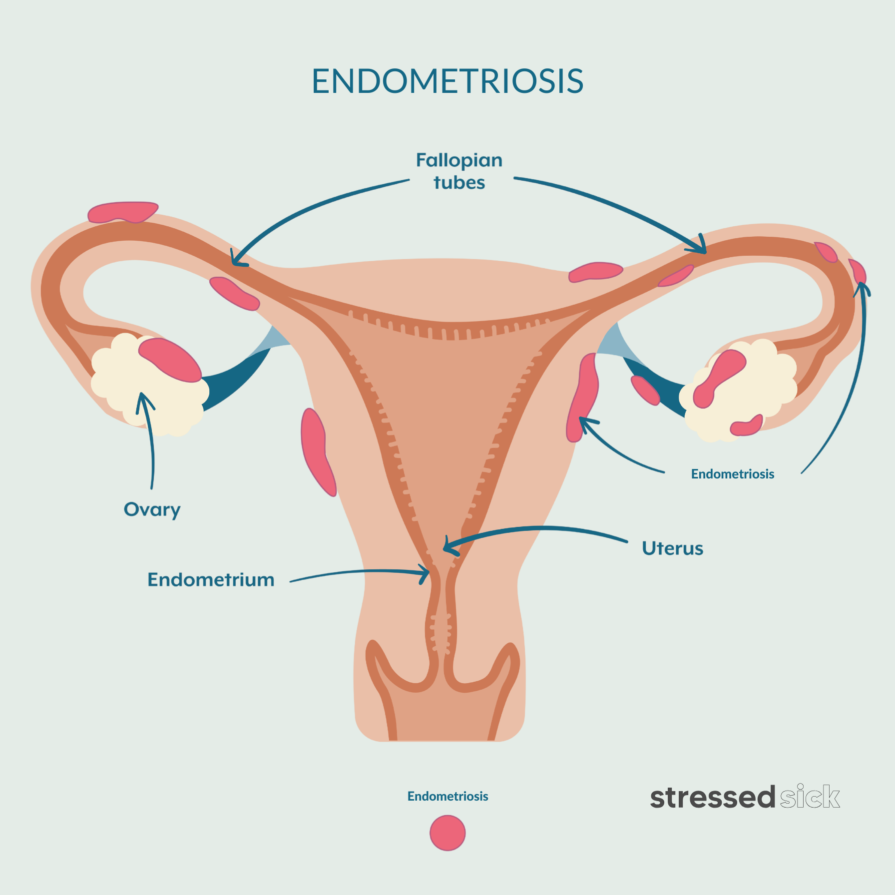 Link to learn about endometriosis symptoms and treatment