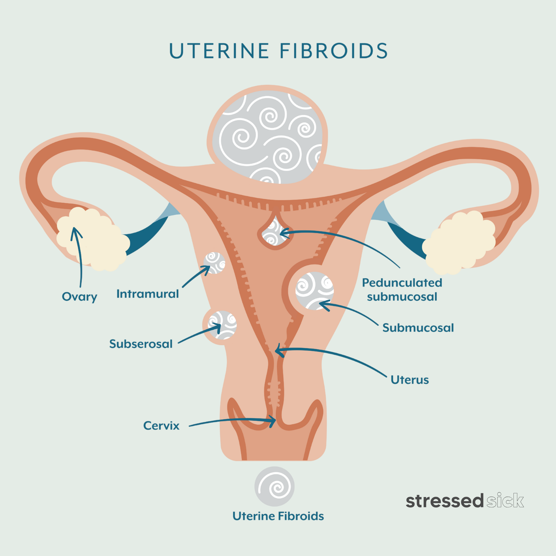 Link to learn about uterine fibroid symptoms and treatment