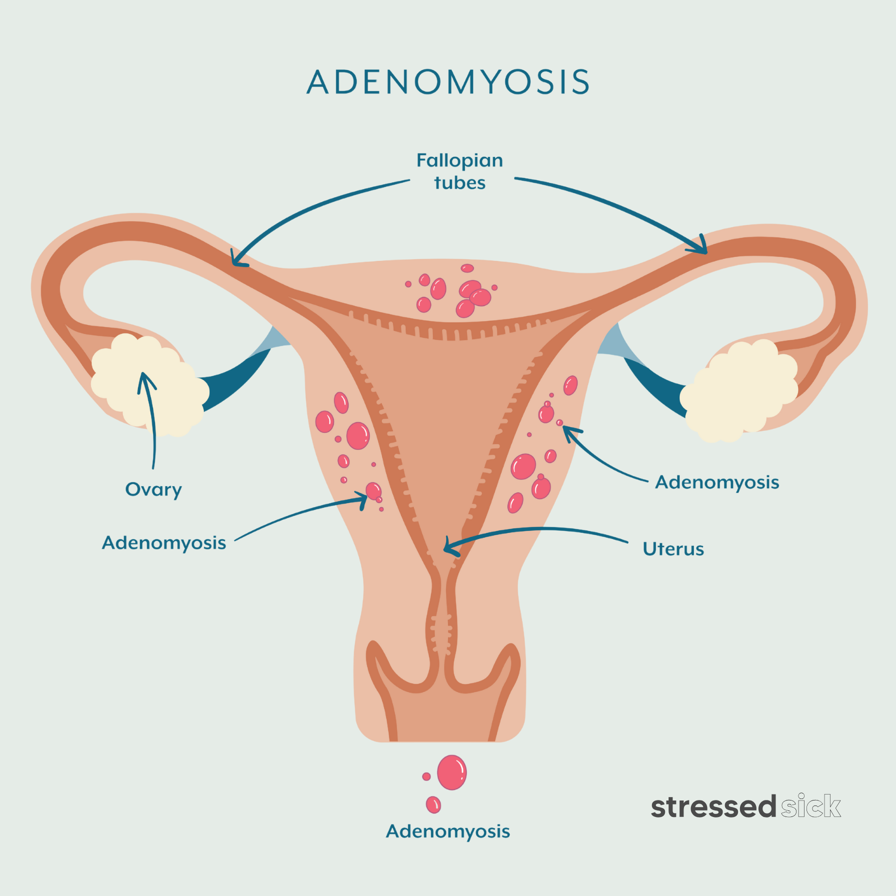 What is adenomyosis? A diagram explaining adeno