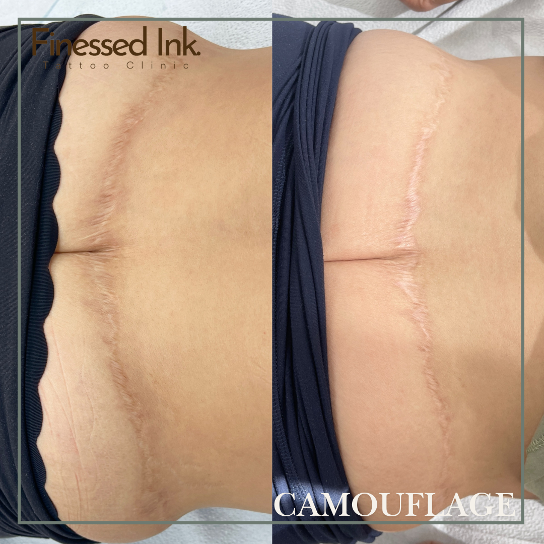 Tummy Tuck Mommy Makeover scar camouflage tattoo