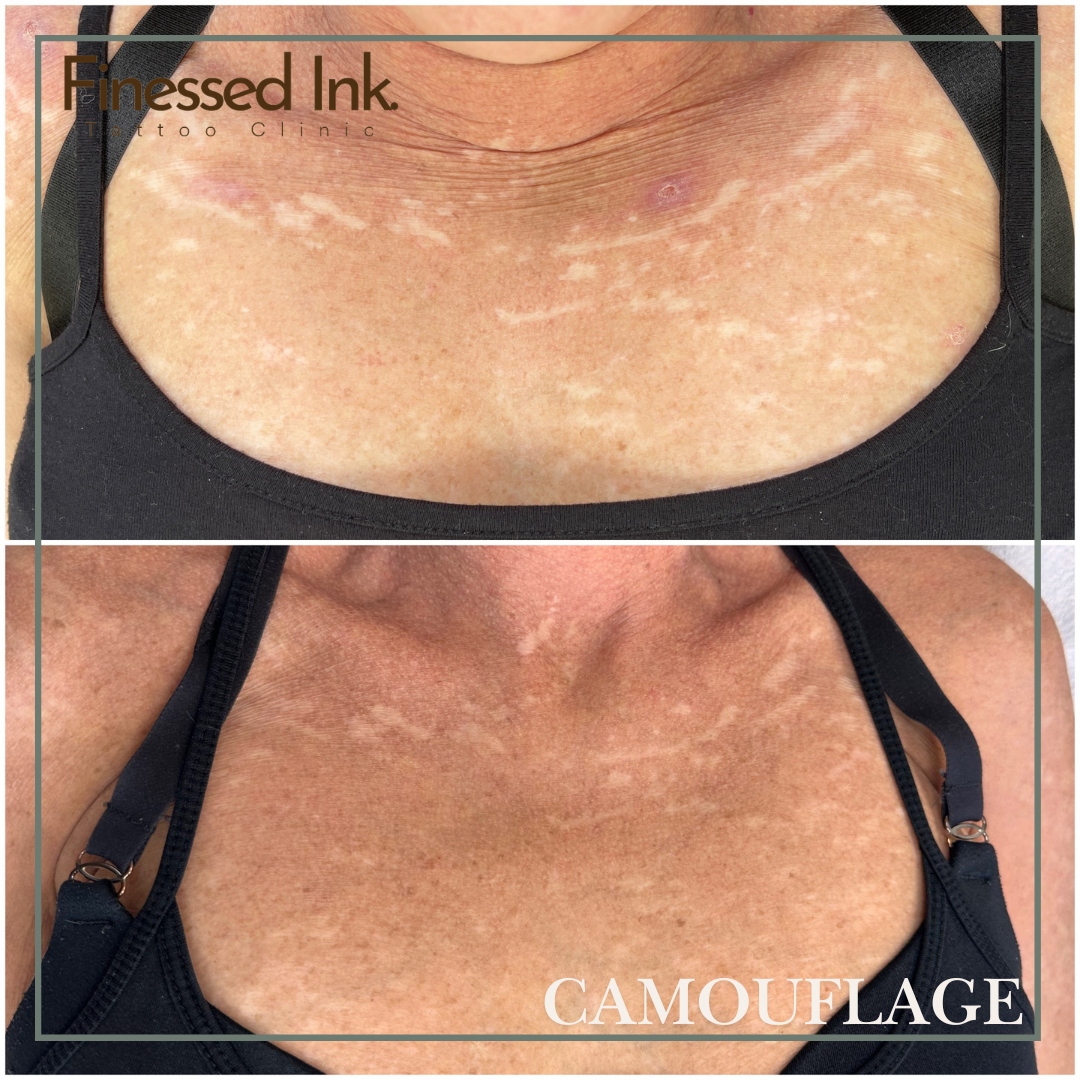 scar camouflage tattoo