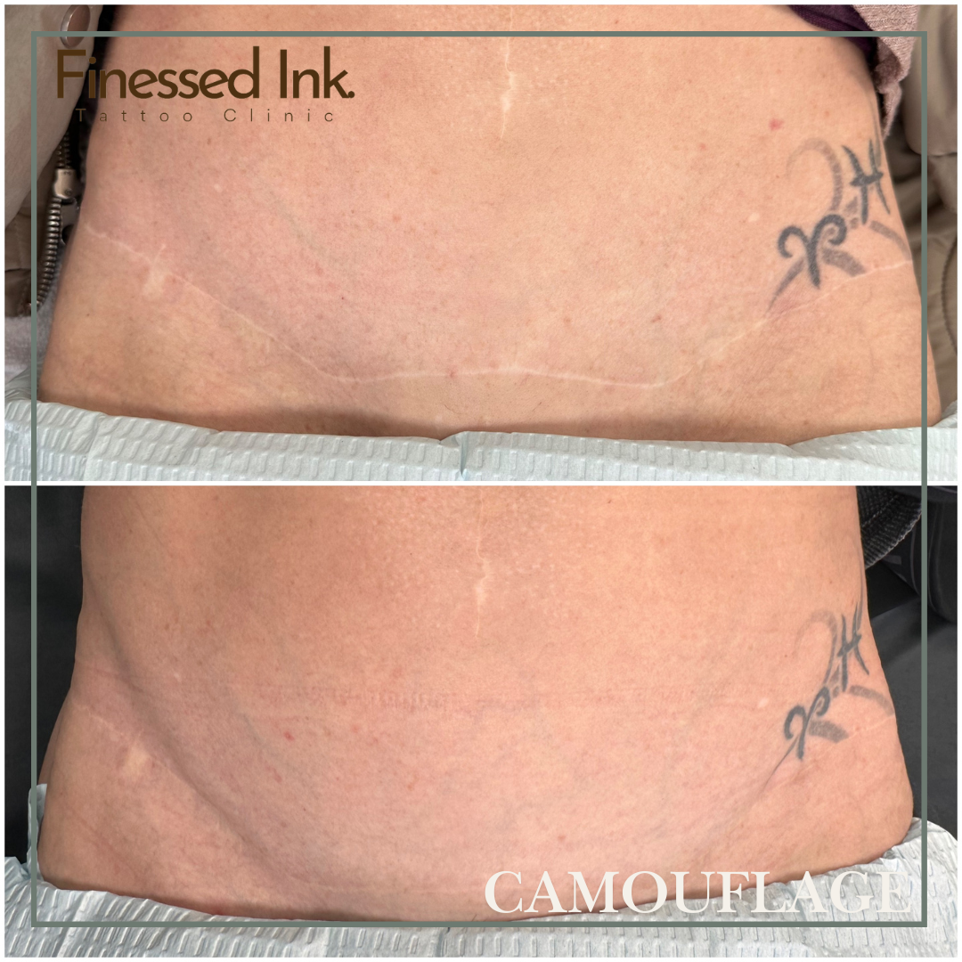Tummy Tuck scar camouflage tattoo