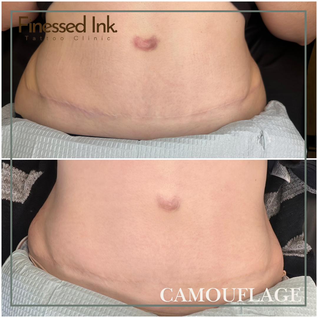 Tummy Tuck scar camouflage tattoo