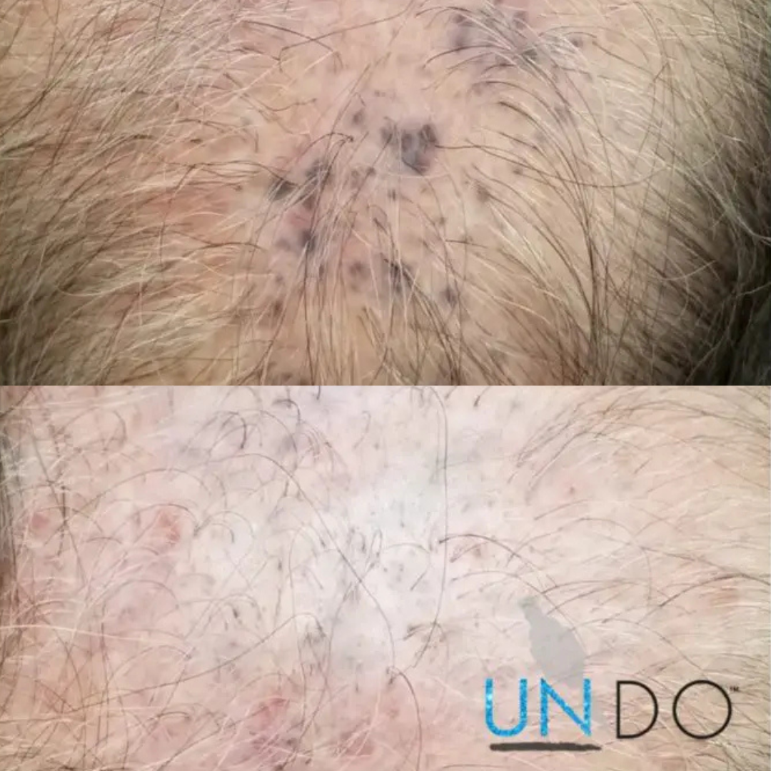 scalp tattoo botched tattoo removal.png