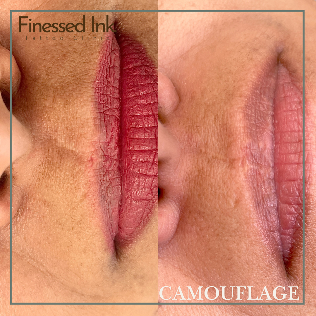 Lip scar camouflage tattoo