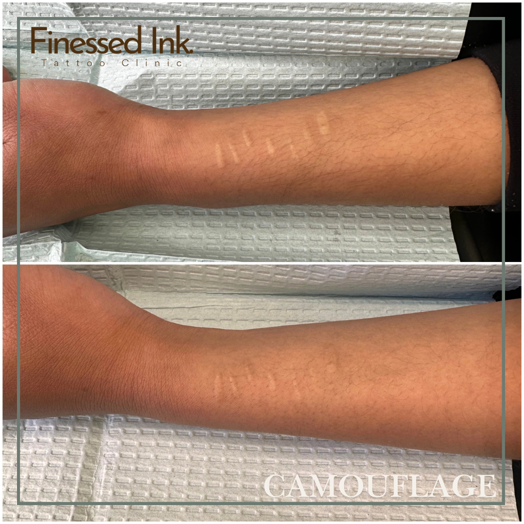 scar camouflage tattoo