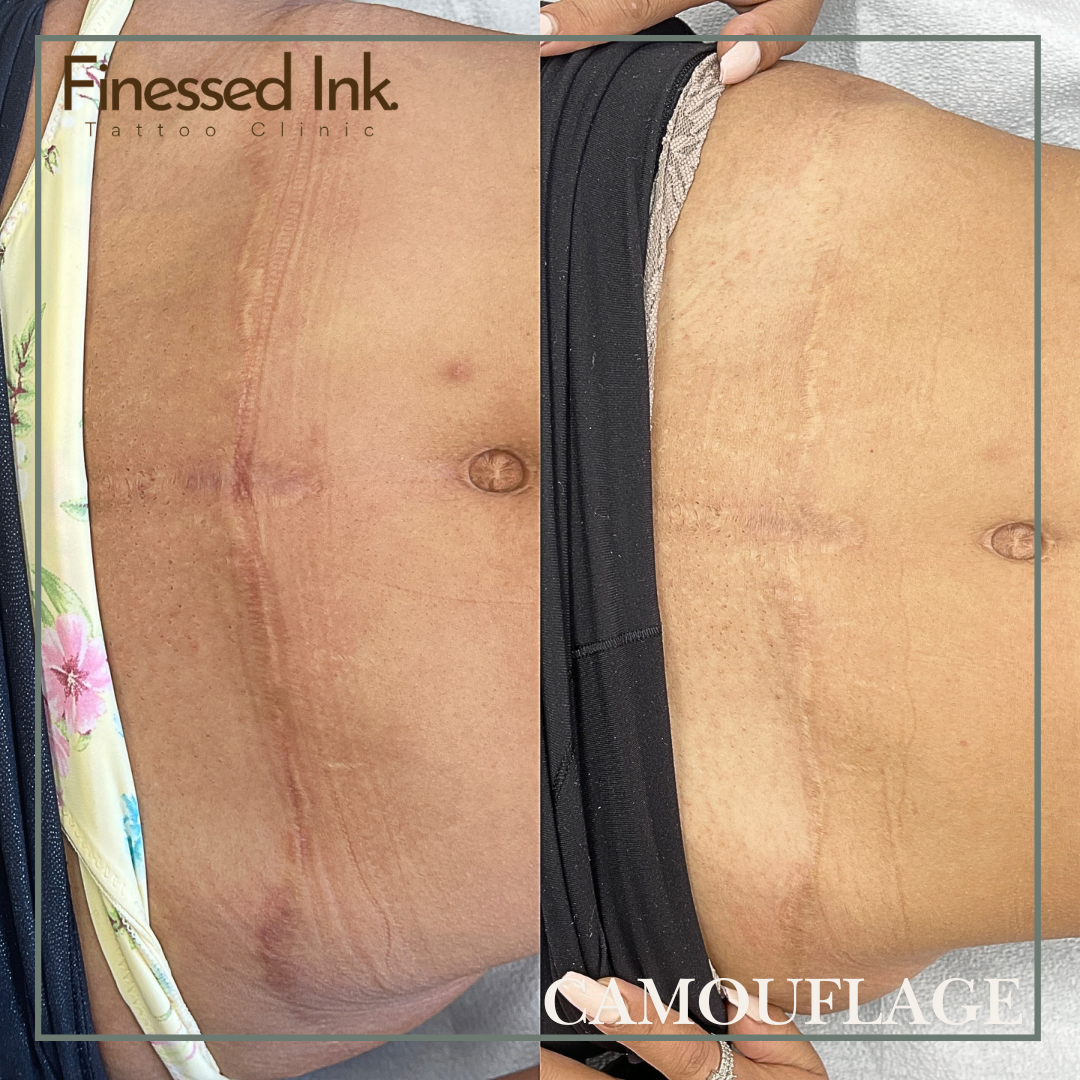 Tummy Tuck Mommy Makeover scar camouflage tattoo