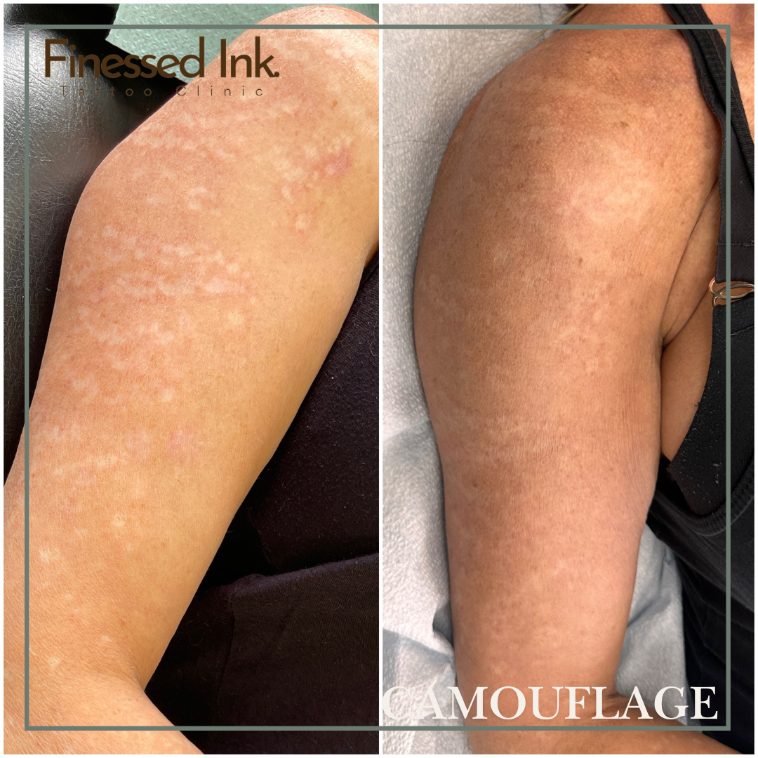 scar camouflage tattoo