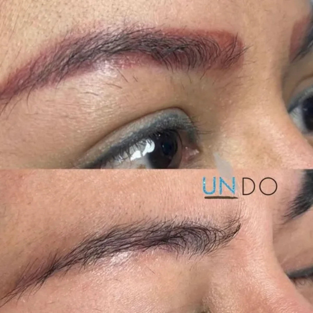 Red eyebrow Microblading tattoo removal.png