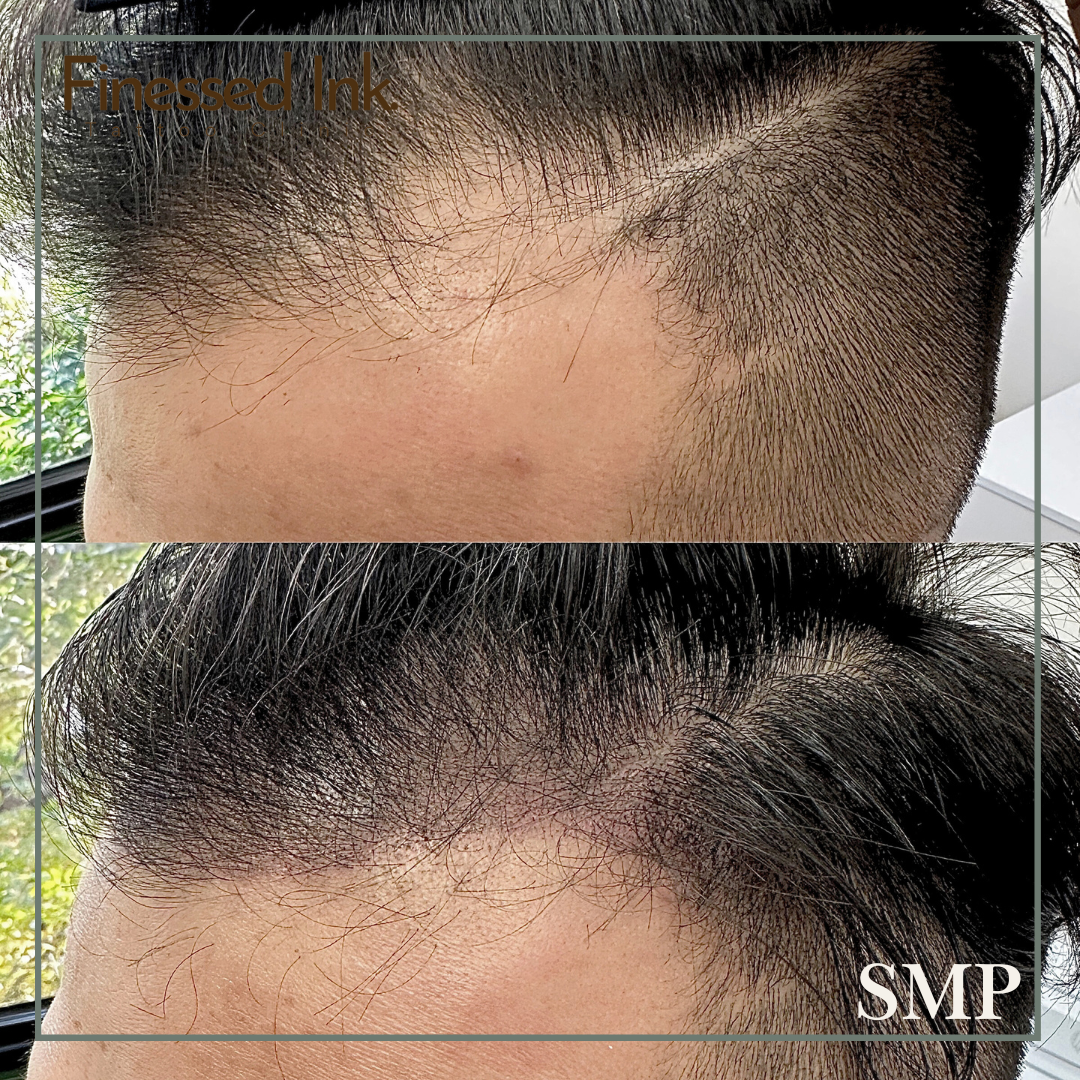 Close-up of a person's hairline before and after a hairline restoration procedure showing significant improvement in hair density.