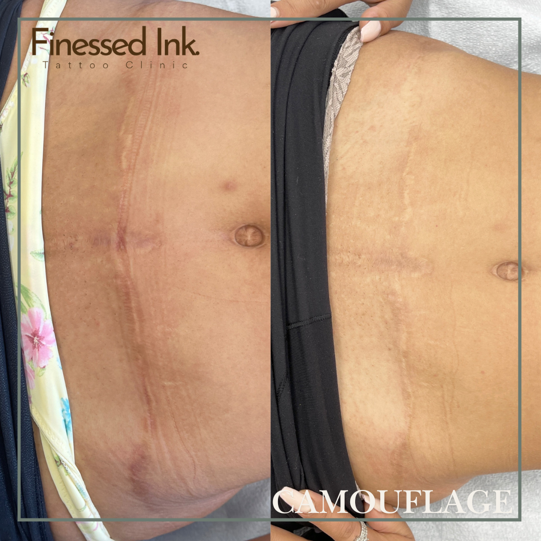 Scar Camouflage tattoo Mommy makeover.png