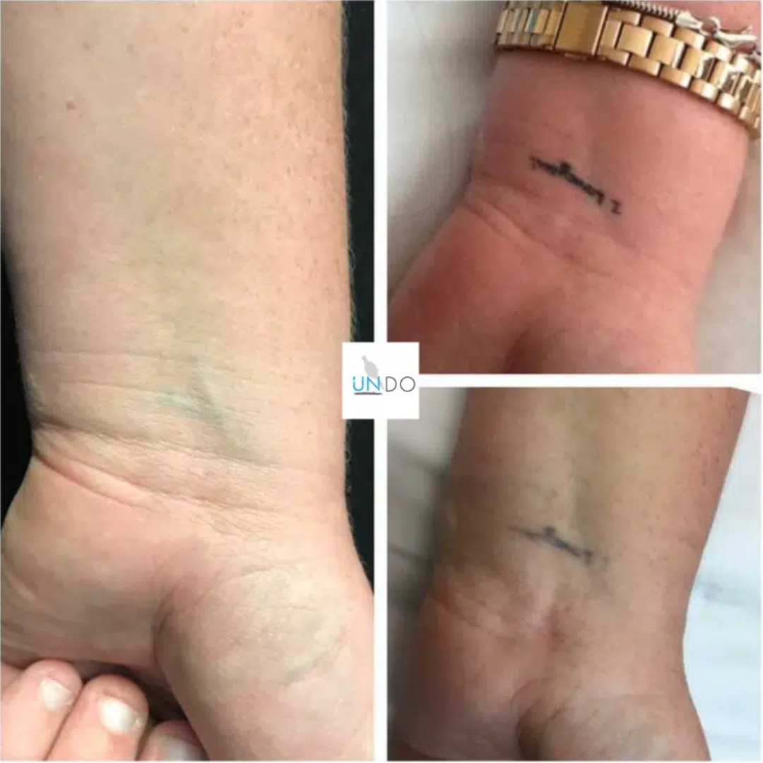 tattoo removal.png