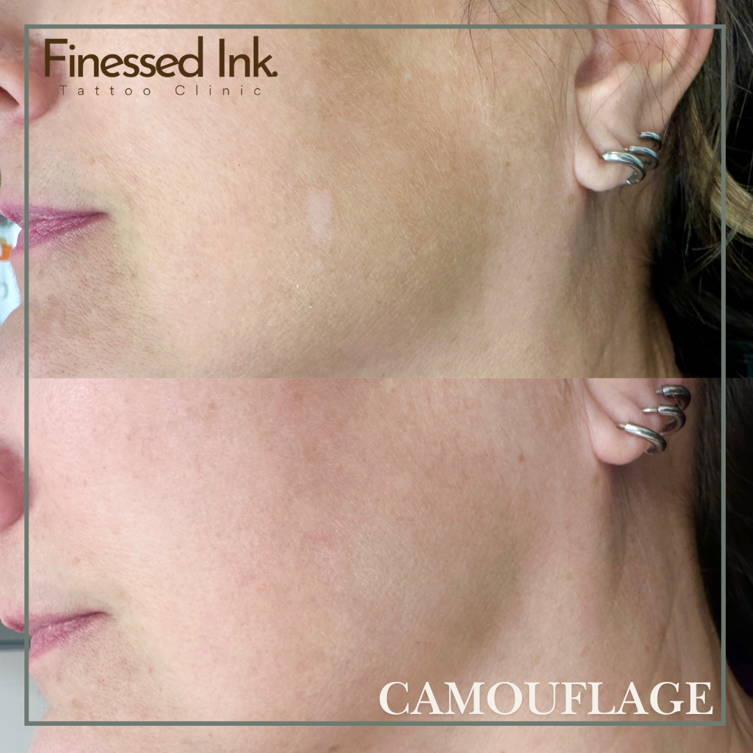 Face scar camouflage tattoo