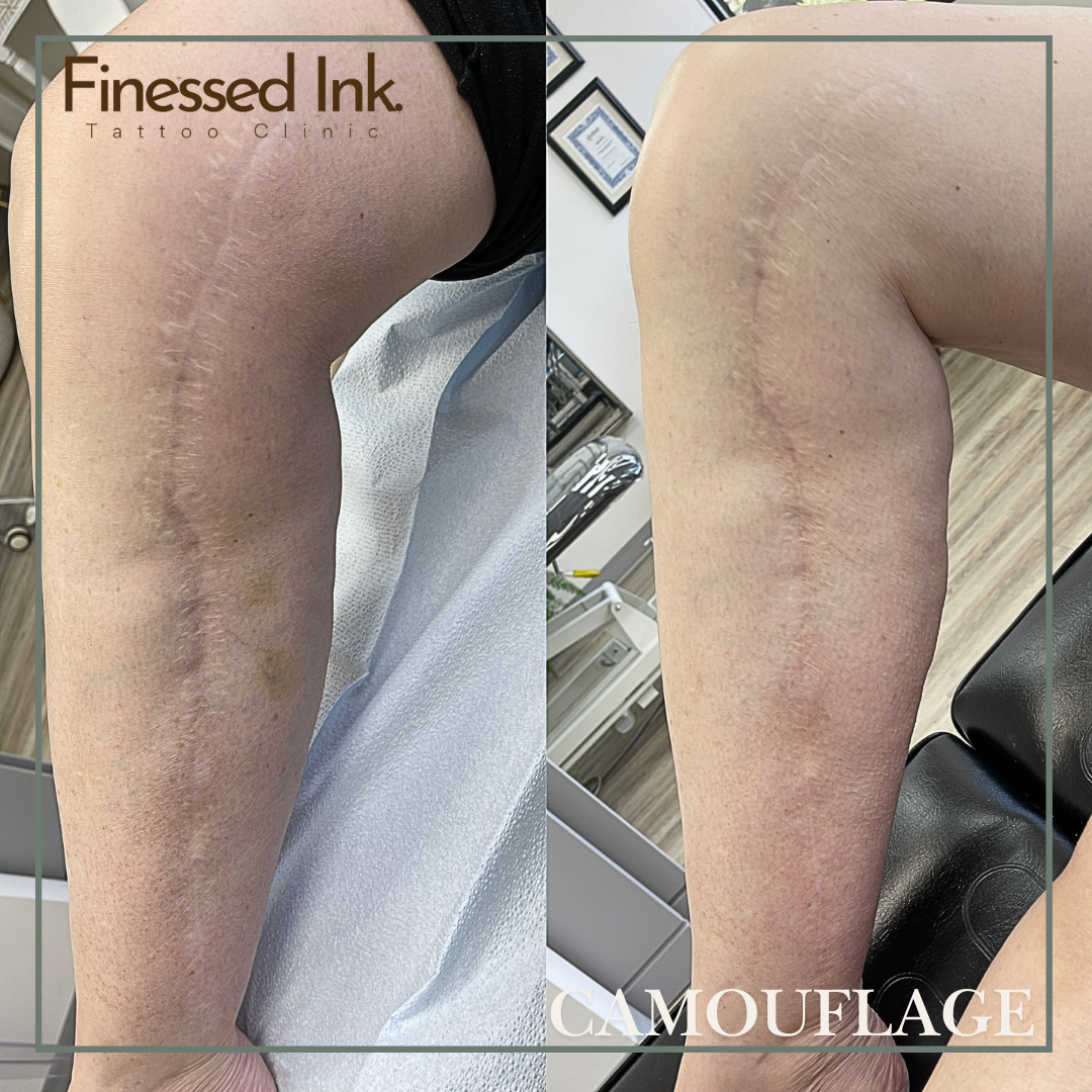 Leg surgical scar camouflage tattoo