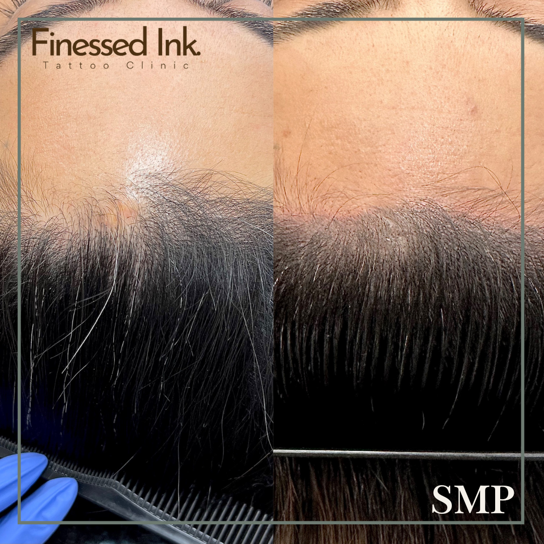 Close-up of a person's scalp and hair before and after tattooing procedure, showing improved hair density on the left side and natural appearance on the right side.