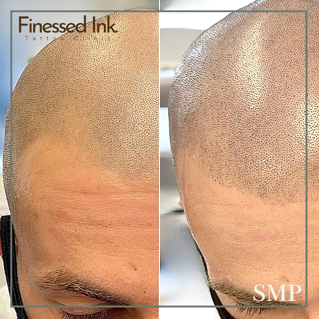 Comparison of a person's scalp before and after Finsseed Ink tattooing for scalp micropigmentation, showing density of hair follicle dots.