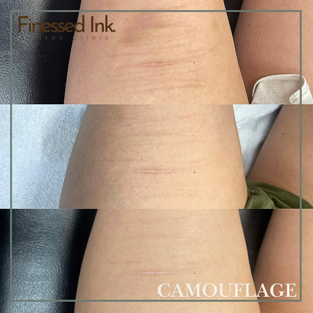 scar camouflage tattoo