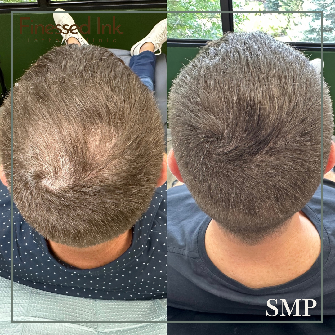 SMP before and after results male crown.png