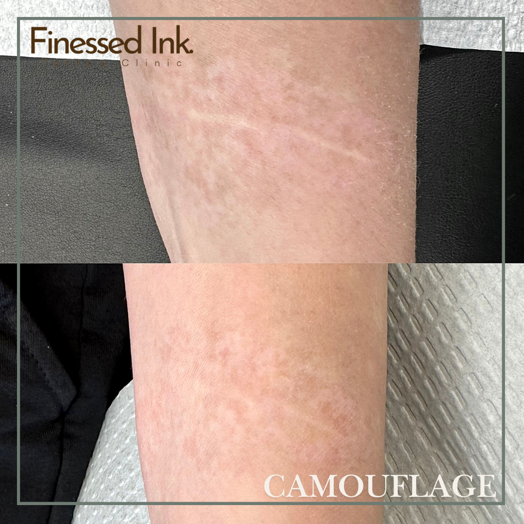 scar camouflage tattoo