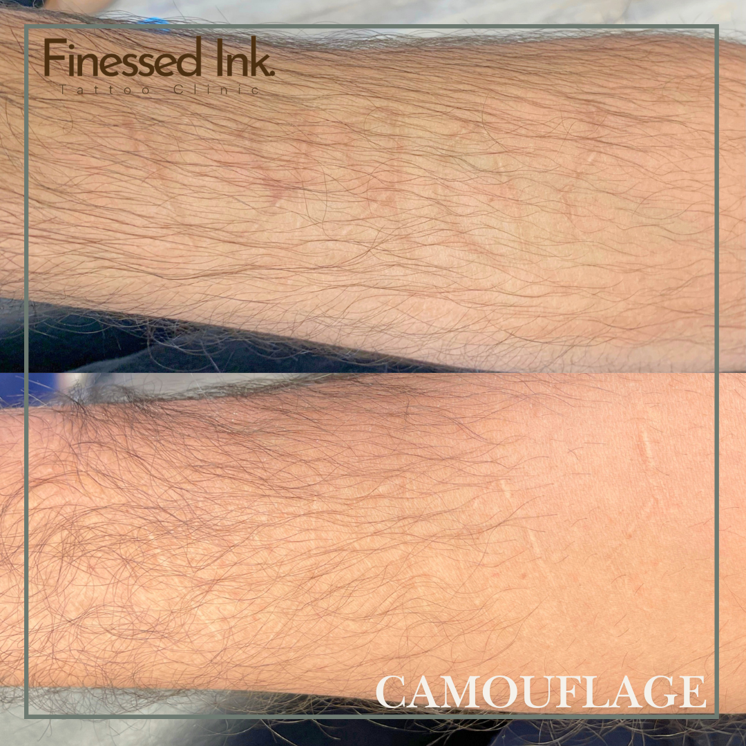 scar camouflage tattoo